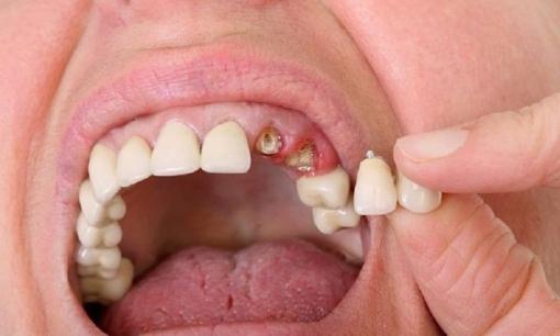 Ngủ mơ bị rụng răng là điềm báo lành hay dữ?