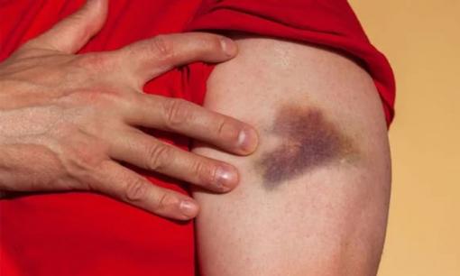 4 triệu chứng 'báo hiệu' ung thư máu đang phát triển trong cơ thể, nếu có dù chỉ 1 cũng phải đi khám ngay, đừng chần chừ