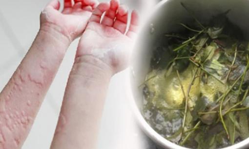 Đây là loại nước lá tắm hết sạch dị ứng, nổi mề đay, mẩn ngứa trong ngày hè nóng bức