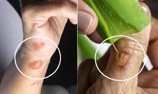 Tôi nên làm gì nếu bị bỏng? 4 mẹo giảm đau, tránh nhiễm trùng và giảm sẹo