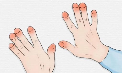 'Ngọn cờ đầu' báo hiệu cơ thể có tế bào ung thư chính là chân tay: Chỉ cần tứ chi có một trong những dấu hiệu sau, phải đi khám ngay!