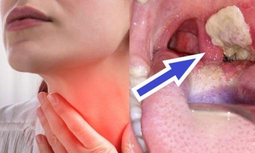 Triệu chứng của bệnh bạch hầu rất giống viêm họng, dựa vào đâu để phân biệt?