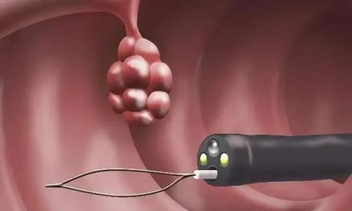 Sau khi cắt bỏ polyp đại trực tràng, tôi nên tái khám bao lâu một lần? Đây là điều bác sĩ khuyên