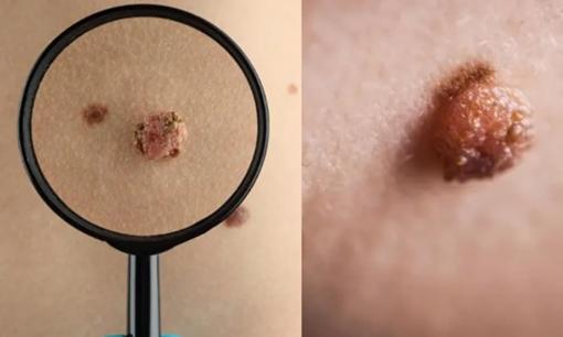 Có nốt ruồi trên cơ thể có nghĩa là bạn bị ung thư? Nốt ruồi ác tính có 5 đặc điểm bạn nên chú ý