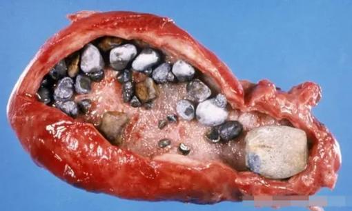 Ung thư túi mật luôn đến một cách âm thầm, các chuyên gia nhắc nhở: nó là “sát thủ vô hình”! Đừng bỏ qua