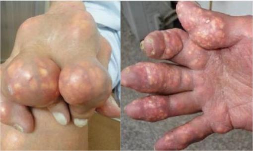 1 loại căn bệnh 'nhà giàu' đang ngày càng trẻ hóa, xuất hiện nhiều ở độ tuổi 25-35 tuổi, đừng chủ quan!