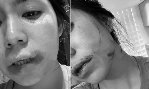 Mới nhất: Hằng Du Mục đăng cận cảnh hình ảnh bị chồng bạo hành, đánh chảy cả máu miệng, tiết lộ thời gian ly hôn