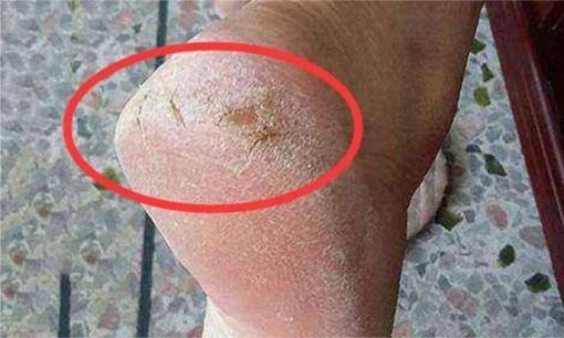 Đừng lo lắng nếu gót chân của bạn bị khô, nứt hoặc đóng vảy. Hãy thử phương pháp này và gót chân của bạn sẽ mịn màng và tinh tế