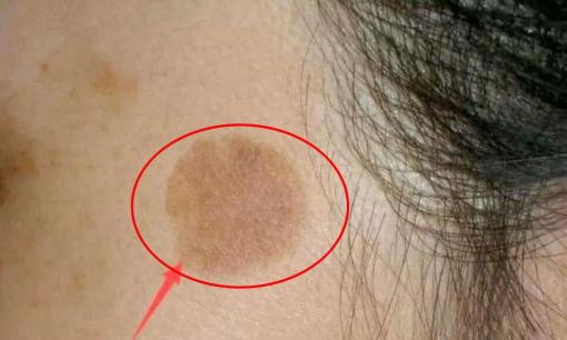 Tại sao một số người có nhiều đốm đồi mồi trong khi những người khác hầu như không có? Câu trả lời là đây 