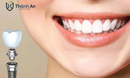 Trồng răng implant giá bao nhiêu? Chi phí chi tiết từng loại implant