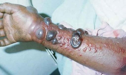 Virus Marburg là gì? Sở Y tế TPHCM kêu gọi người dân hạn chế đi du lịch không cần thiết ở các quốc gia đang bùng phát dịch