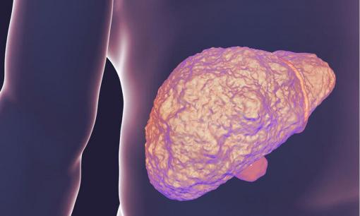 Có một số dấu hiệu chính của bệnh xơ gan và ung thư gan, bạn nên cảnh giác ngay khi chúng xuất hiện