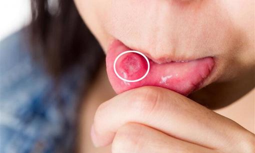 Nếu trong cơ thể có ung thư, miệng có cảnh báo? Nhắc nhở: 4 dấu hiệu này xuất hiện trong miệng, có thể ung thư đang đến gần