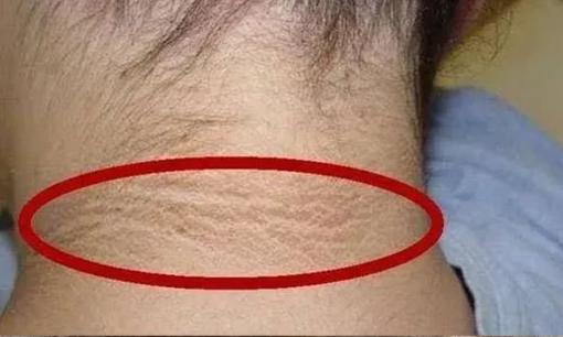 Nói trắng ra: Nếu trên cổ xuất hiện 3 “dấu hiệu này” thì có thể là tế bào ung thư muốn “thức dậy”, đừng bỏ qua