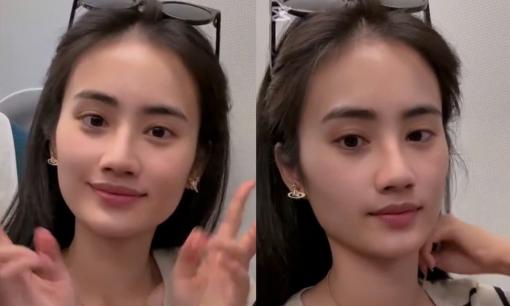 Hoa hậu Ý Nhi tự tin khoe mặt mộc hậu phẫu thuật thẩm mỹ