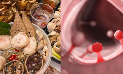 Bác sĩ cảnh báo 4 loại thực phẩm bạn cần ăn càng ít càng tốt để tránh nguy cơ polyp ruột chuyển thành ung thư