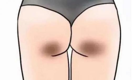 Tại sao con gái luôn có hai “vết đen” ở mông? Tiết lộ bí mật nhỏ của các cô gái 