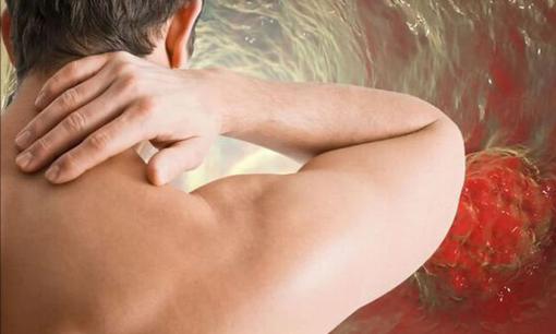 Những triệu chứng ở vai có thể là dấu hiệu báo trước của ung thư gan 