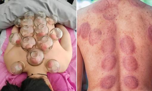 Liệu giác hơi có hút hết chất độc, máu ứ đọng ra khỏi cơ thể không? Nói thật với bạn, bạn sẽ hiểu thêm sau khi đọc nó