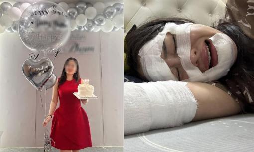 Cảnh báo: Cô gái bỏng nặng toàn bộ gương mặt khi bóng bay bén lửa, bữa tiệc sinh nhật trở thành cơn 'ác mộng'