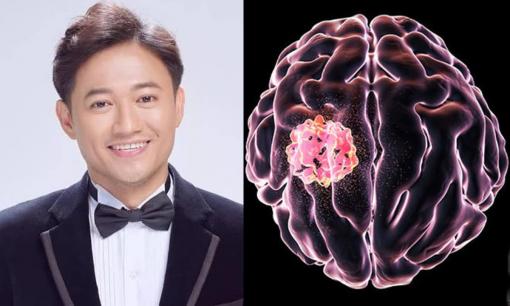 Bệnh u não nguy hiểm thế nào? Ai có dấu hiệu này cần đi kiểm tra ngay trước khi quá muộn