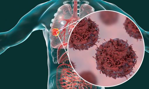 Phổi có bị ung thư không? Chỉ cần nhìn giấc ngủ là biết! Nếu bạn bị ung thư phổi, bạn thường sẽ gặp 5 triệu chứng khi ngủ vào ban đêm