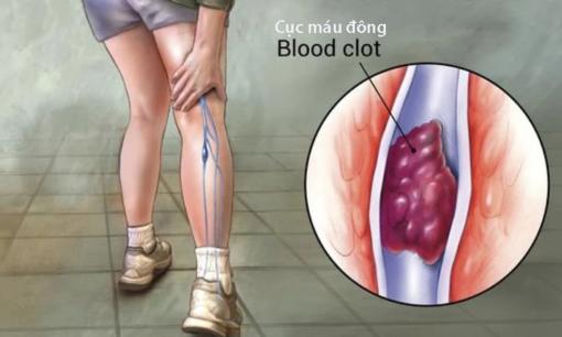 Bạn có thể biết một người có cục máu đông hay không bằng cách đi bộ? Lời khuyên: Người bị cục máu đông thường có 3 bất thường khi đi bộ