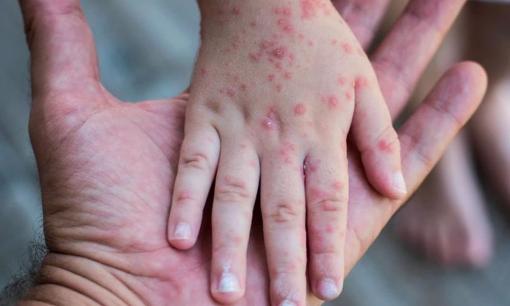 Bị bệnh sởi một lần rồi có thể bị mắc lại nữa không?