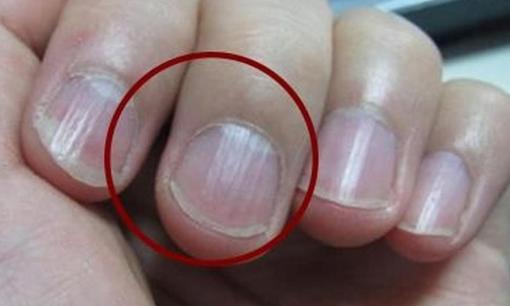 Tại sao lại có đường sọc thẳng trên móng tay? Nếu  có 4 bất thường này, thì đó có thể là dấu hiệu của những vấn đề sức khoẻ này