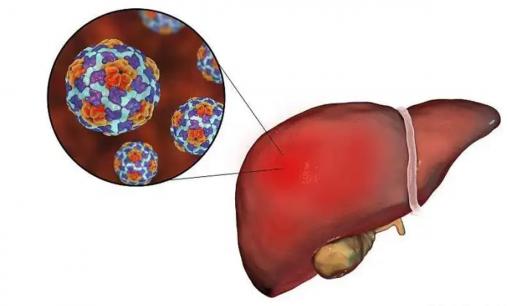 Phải mất bao nhiêu năm từ khi bị viêm gan B đến ung thư gan? Lời nhắc nhở: Nắm bắt bốn tín hiệu ung thư và phanh kịp thời