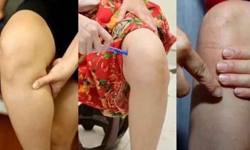 Đầu gối của bạn có bị sưng lên khi đứng hoặc đi bộ trong thời gian dài không? Hãy ấn 'Tam giác tăng cường sức mạnh' ở đầu gối trong 3 phút mỗi ngày để giảm đau