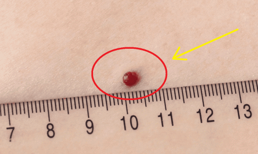 Những nốt ruồi như thế này có thể biến thành ung thư! Cách xử lý đúng đắn khi có nốt ruồi 'đáng ngờ'