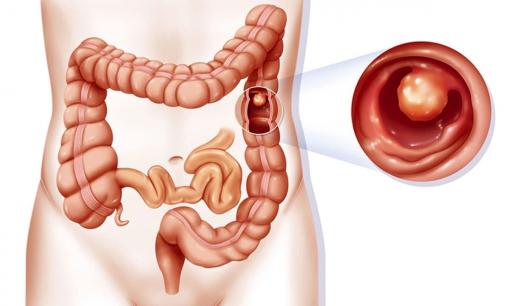 Có một loại polyp đại tràng, gần 100% chuyển thành ung thư! Bốn triệu chứng khi đi vệ sinh, báo hiệu polyp sắp xuất hiện