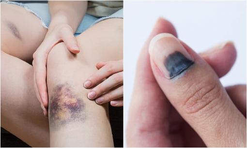 Cảnh báo sức khỏe: 5 vùng trên cơ thể chuyển sang màu đen, chứng tỏ bạn đang mắc ung thư, chỉ tiếc không ai để ý!