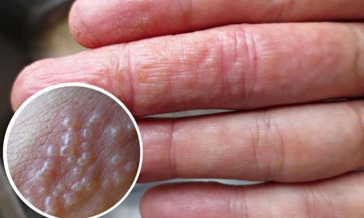 Đừng bỏ qua 4 dấu hiệu trên ngón tay: Cảnh báo ung thư gan, phổi sớm