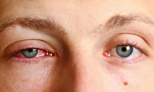 4 thay đổi bất thường ở đôi mắt chứng tỏ bạn đang bị ung thư, tiếc không ai để ý