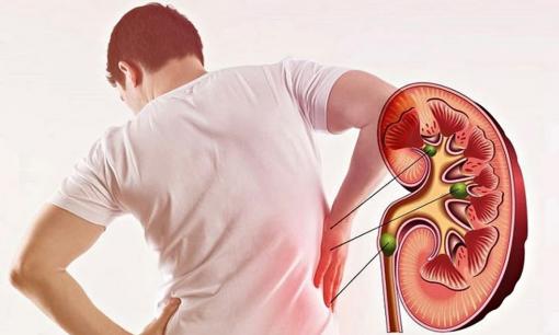 Cảnh báo: Một thói quen xấu mà nhiều người hay mắc phải, đặc biệt dân văn phòng, có thể gây suy thận, phải chạy thận cả đời