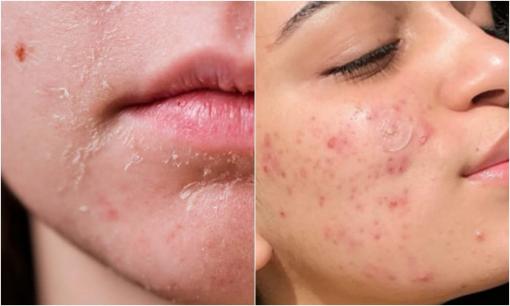 4 thay đổi trên khuôn mặt là dấu hiệu cảnh báo ung thư cổ tử cung, chị em phụ nữ đừng chủ quan 