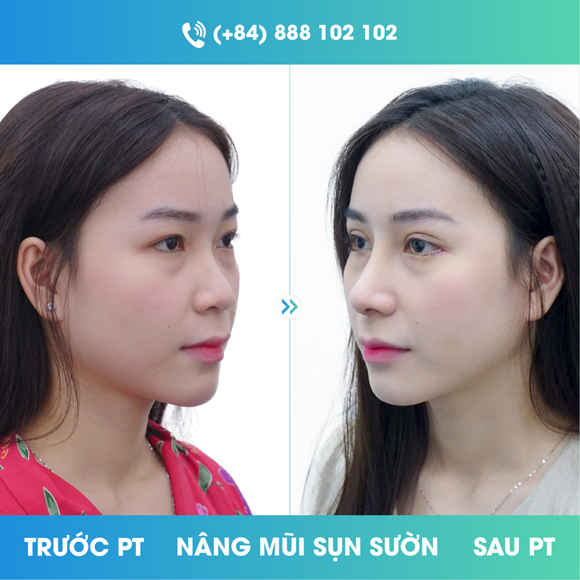 khach-hang-ngoc-yen-1510-ngoisao.vn-w580-h580 0 Viện thẩm mỹ Newface, Phẫu thuật thẩm mỹ, Nâng mũi