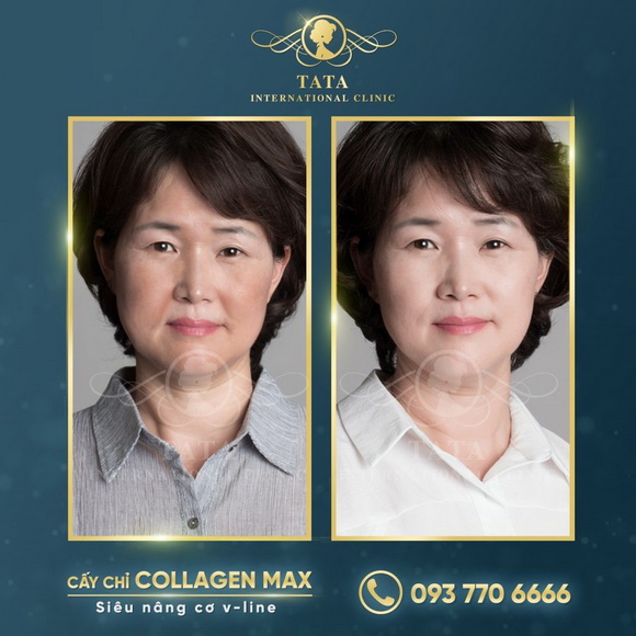 tata-clinic-2410-2-ngoisao.vn-w580-h580 4 Trẻ hóa da, Làm đẹp không dao kéo, TaTa International Clinic
