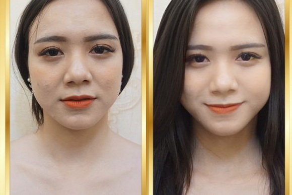 tata-clinic-2410-4-ngoisao.vn-w580-h387 2 Trẻ hóa da, Làm đẹp không dao kéo, TaTa International Clinic