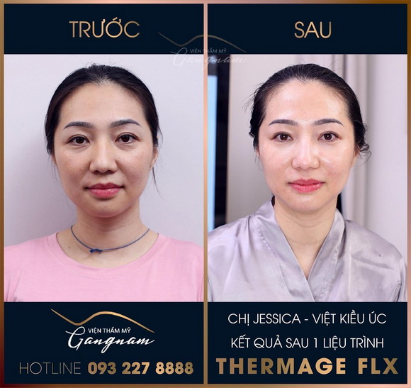 tre-hoa-da-711-1-ngoisao.vn-w580-h547 4 Viện thẩm mỹ Mega Gangnam, Trẻ hóa da, Xóa bỏ nếp nhăn