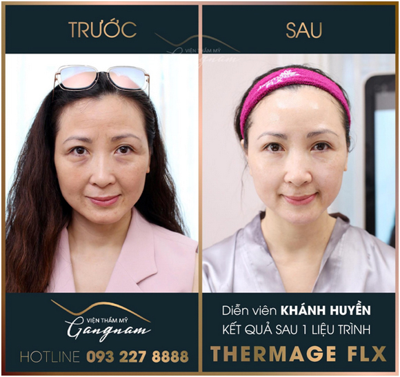 tre-hoa-da-711-11-ngoisao.vn-w580-h547 1 Viện thẩm mỹ Mega Gangnam, Trẻ hóa da, Xóa bỏ nếp nhăn