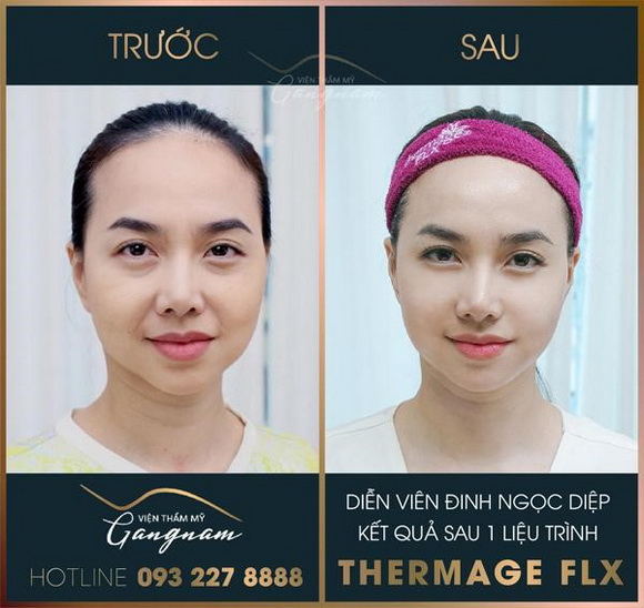 tre-hoa-da-711-2-ngoisao.vn-w580-h548 3 Viện thẩm mỹ Mega Gangnam, Trẻ hóa da, Xóa bỏ nếp nhăn