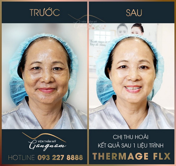 tre-hoa-da-711-3-ngoisao.vn-w580-h547 2 Viện thẩm mỹ Mega Gangnam, Trẻ hóa da, Xóa bỏ nếp nhăn