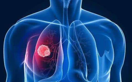 ung thư, ung thư phổi, biểu hiện của ung thư phổi