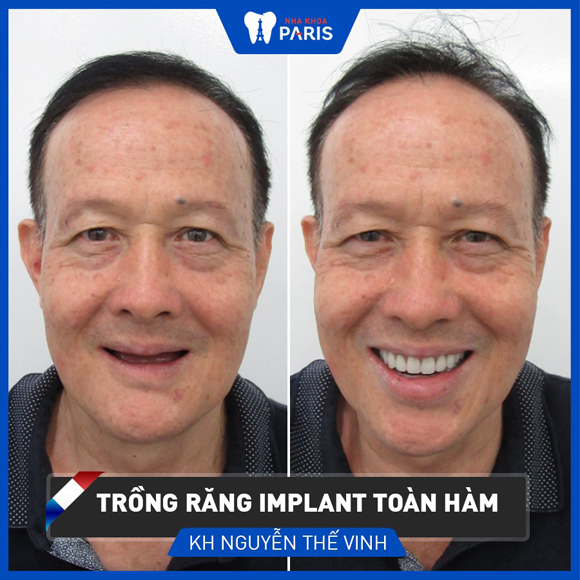 Trồng răng implant, Nha khoa paris