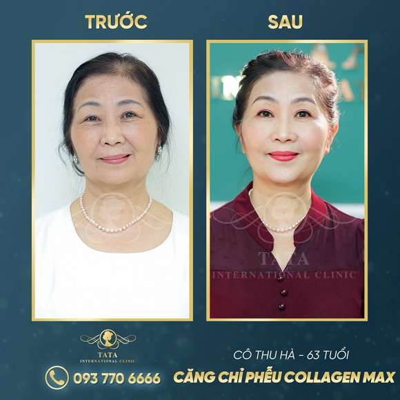 Top 3 cách trị vết chân chim quanh mắt hiệu quả nhất