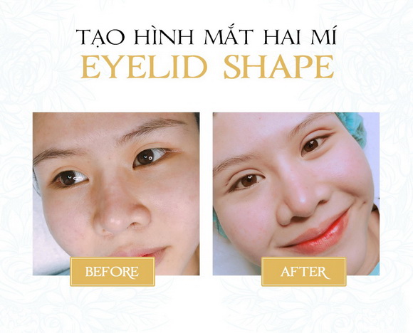 Tạo hình mắt hai mí, SHE CENTER, EYELID SHAPE, CEO Đỗ Thị Thu Mai