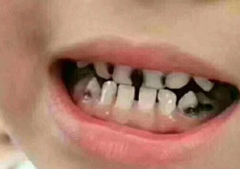 Miệng bé 3 tuổi đầy 'răng đen', không phải vì đường, mà là hai thói quen này của nhiều bố mẹ